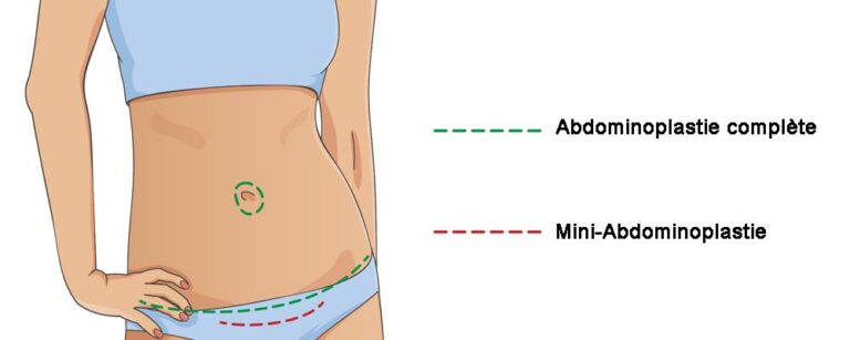 Mini-abdominoplastie
