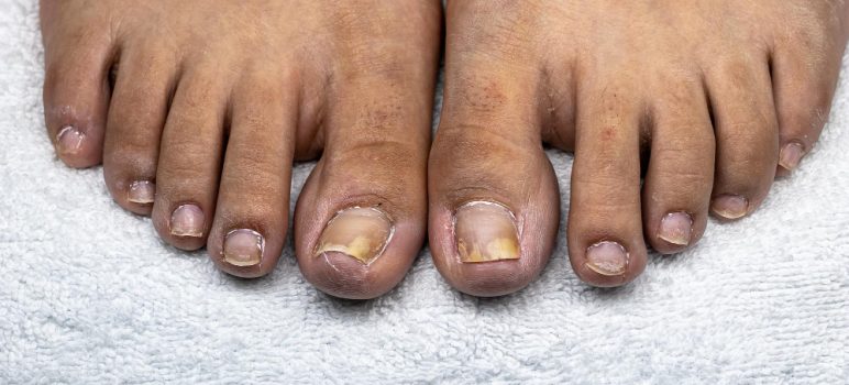 Bain de pied à la javel contre la mycose